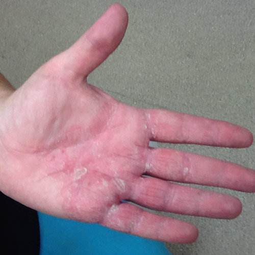 Eczema On The Hand