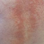 Eczema On The Back