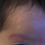 Eczema On The Head