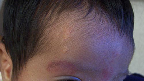 Eczema On The Head