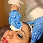 Micro-Needling On The Face