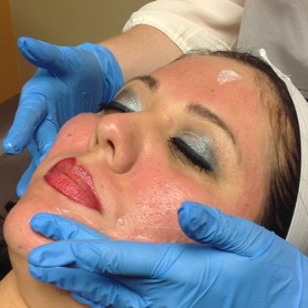 Micro-Needling On The Face