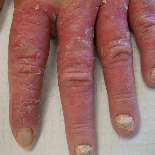 Psoriasis On The Hand