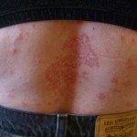 Psoriasis On The Back