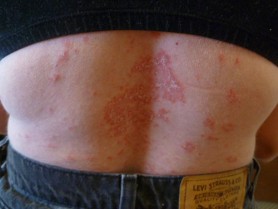 Psoriasis On The Back