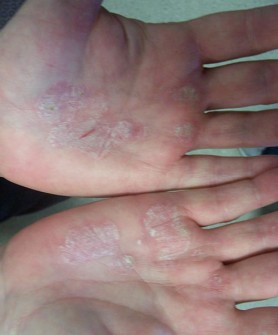 Psoriasis On The Hands