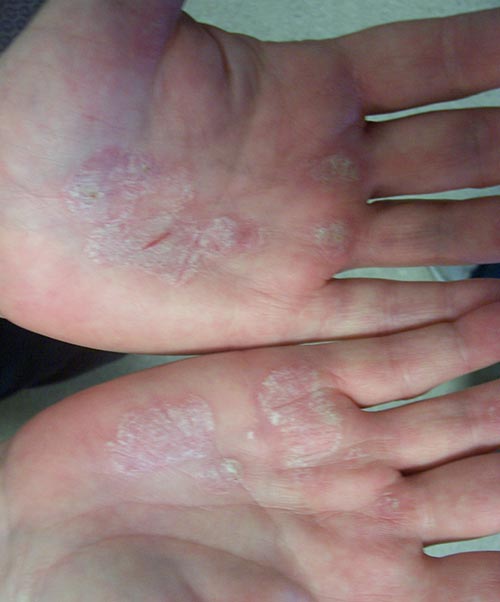 Psoriasis On The Hands