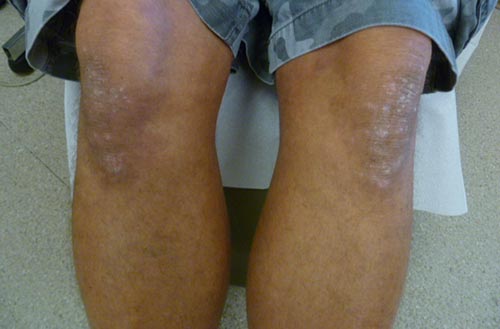 Psoriasis On The Legs
