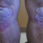 Psoriasis On The Knees