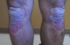 Psoriasis On The Knees