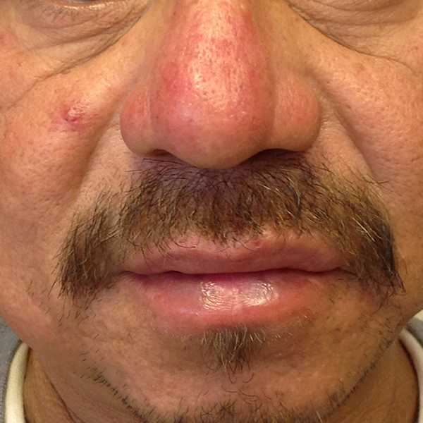 Rosacea on the Nose