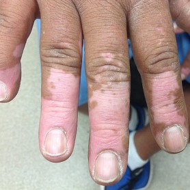 Vitiligo On The Hand