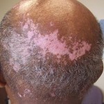 Vitiligo On The Head
