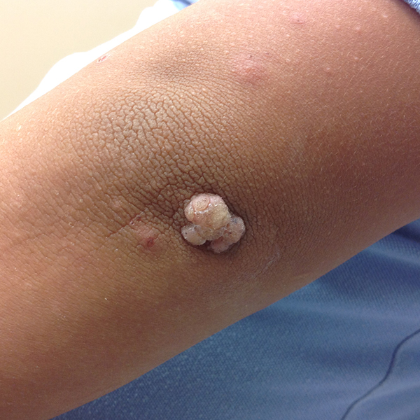 Wart on the Arm