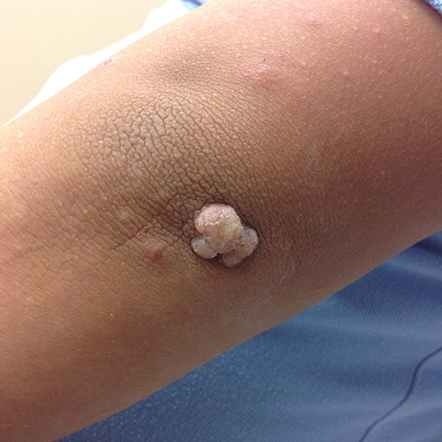 Wart on the Arm