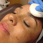 Chemical Peel On The Face