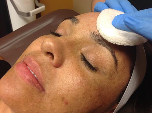 Chemical Peel On The Face