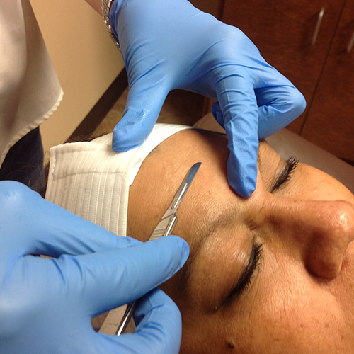 Dermaplaning On The Face