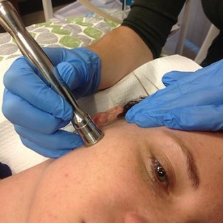 Microdermabrasion On The Face