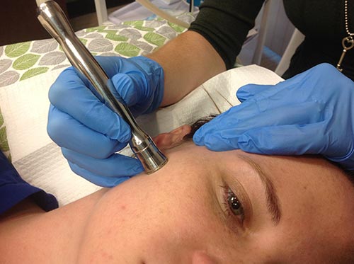 Microdermabrasion On The Face