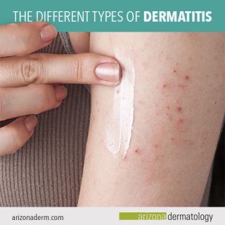 The Different Types of Dermatitis | Arizona Dermatology