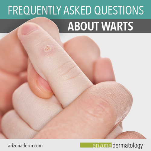 Common Questions About Warts | Arizona Dermatology 