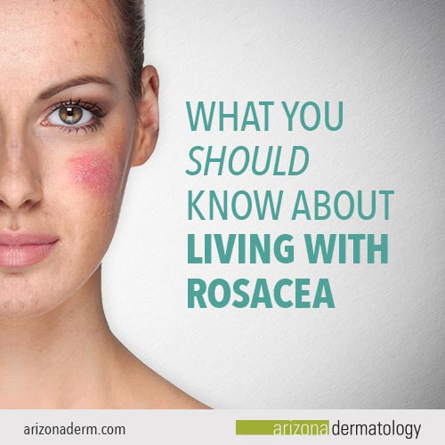 What You  Should Know About Living with Rosacea | Arizona Dermatology