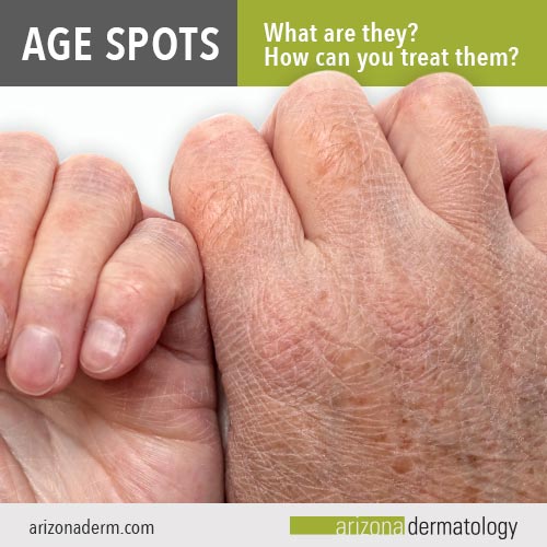 What are age spots? | Arizona Dermatology 