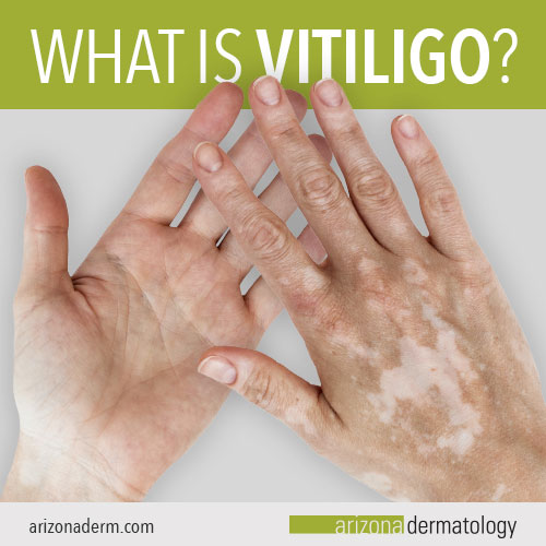 What is Vitiligo? | Arizona Dermatology