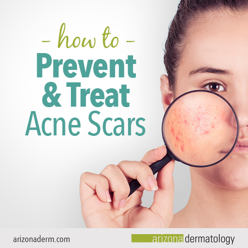 How to prevent and treat acne scars