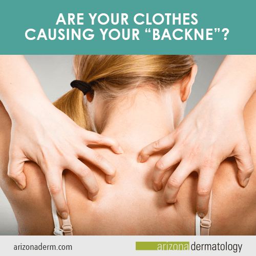 Are your clothes causing your “backne”?