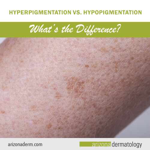 Hyperpigmentation vs. Hypopigmentation- What's the Difference?