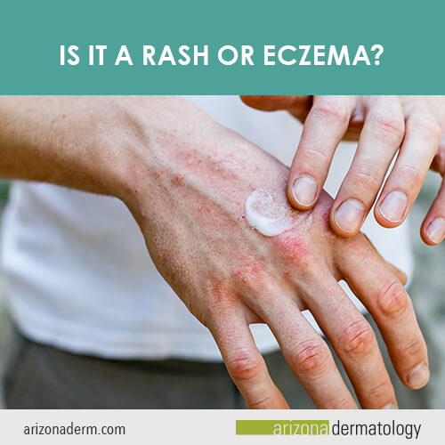 Is it a Rash or Eczema?