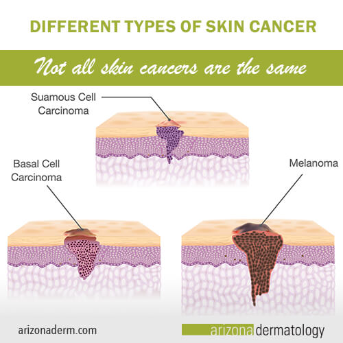 Melanoma Skin Cancer Diagram