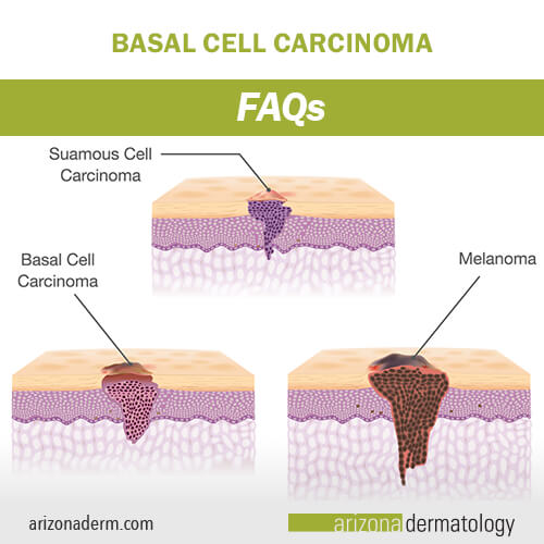 Basal Cell Carcinoma Faqs