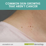 Common Skin Growths that Aren’t Cancer