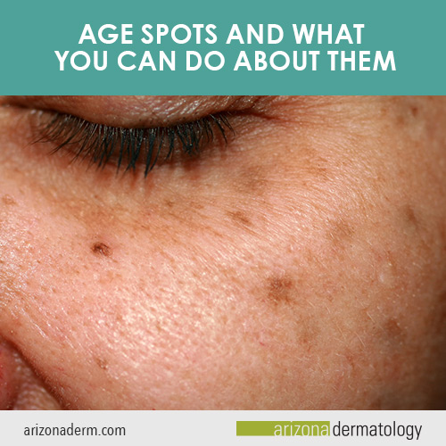 Age Spots and What You Can Do About Them