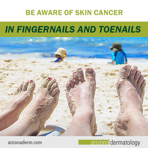 Be Aware of Skin Cancer in Fingernails and Toenails (Subungual Melanoma)